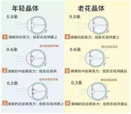 近視就不會(huì )老花了嗎？